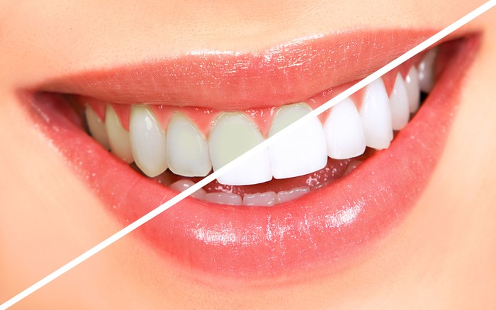 Teeth Whitening for Teens
