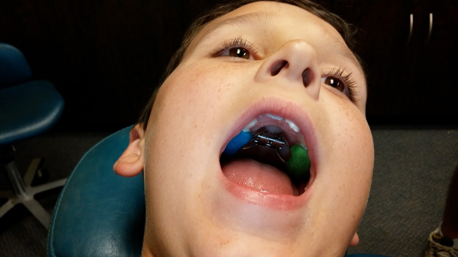 Palatal Expanders: What They Help… and How