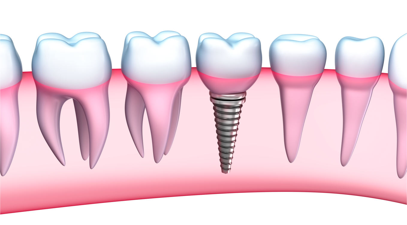 Are Dental Implants in Your Future?