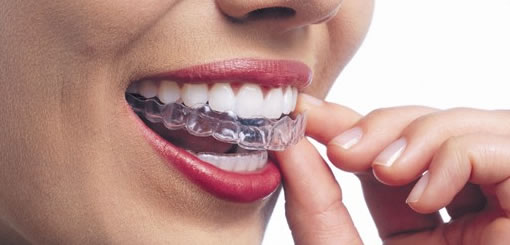 Invisalign